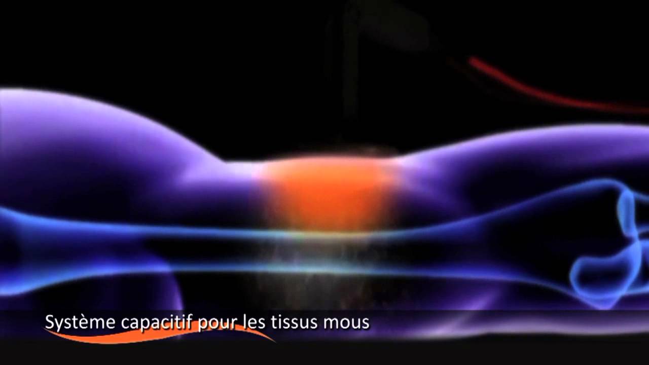 Qu'est-ce qu'INDIBA® activ ?