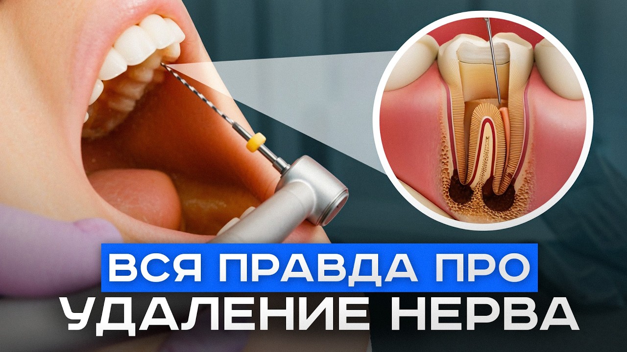 НЕ УДАЛЯЙ НЕРВ, пока не посмотришь видео! Зачем удалять нерв?