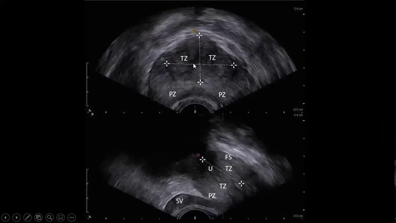 PROSTATA. Anatomía e HPB.