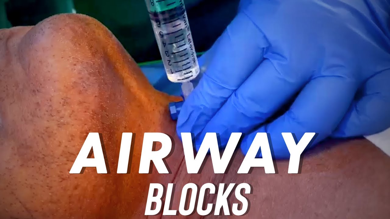 Airway Blocks Anesthesia ! SLN & Transtracheal Block.