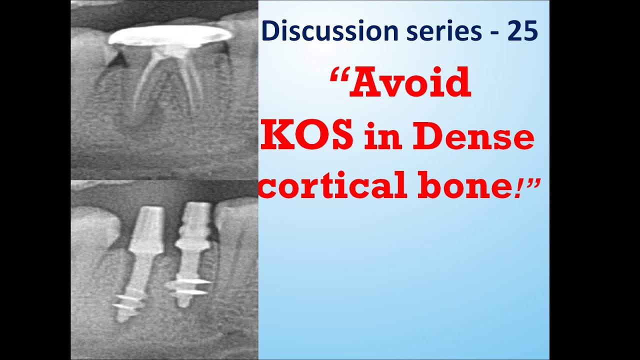 Treatment options for lower first molar with BCS  implants - Best laser dental clinic Chennai