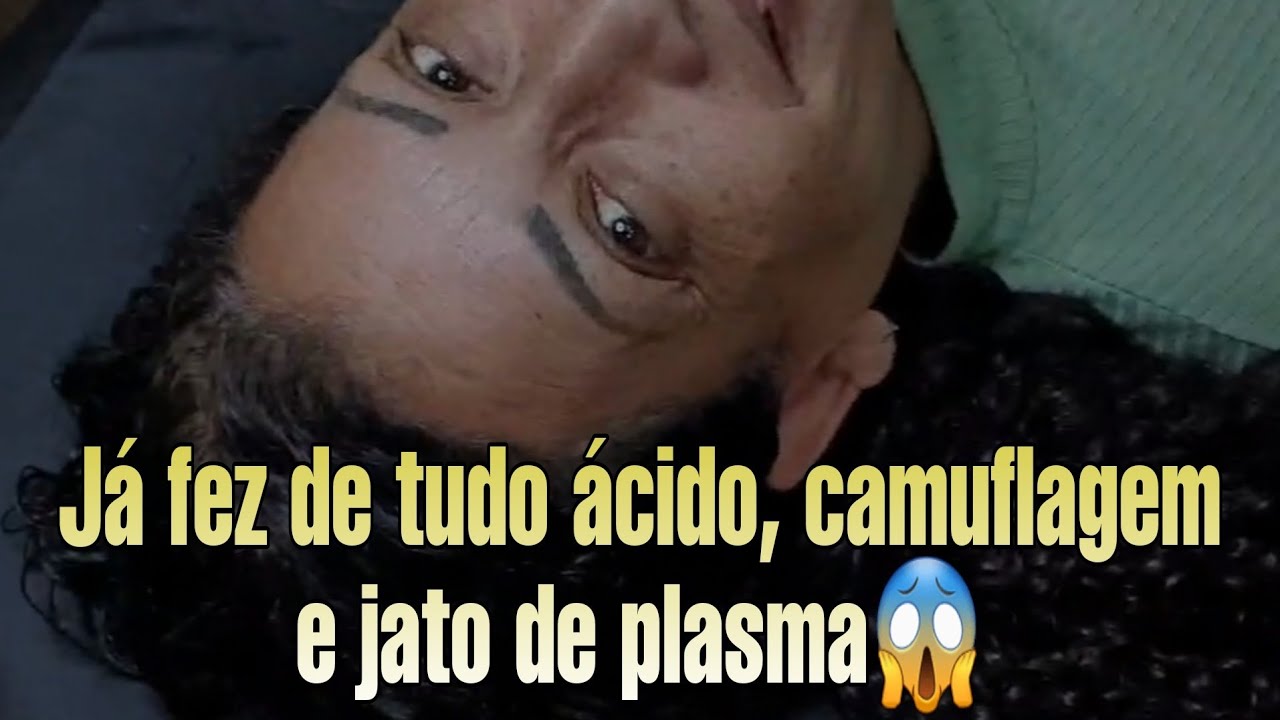 Remoção de micropigmentação. Ela já fez ácido,  camuflagem e jato de plasma