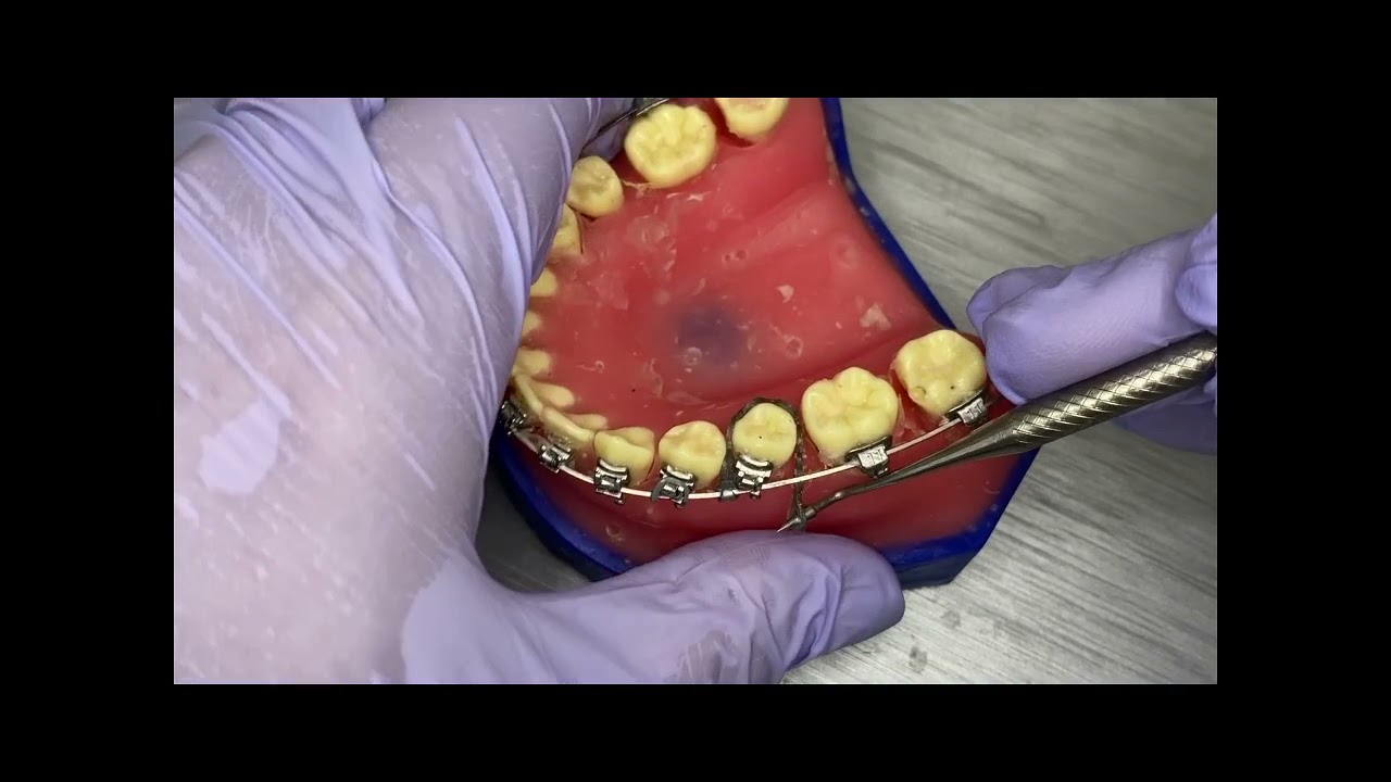 Dicas de Ortodontia e Ortopedia: Como girar um dente.