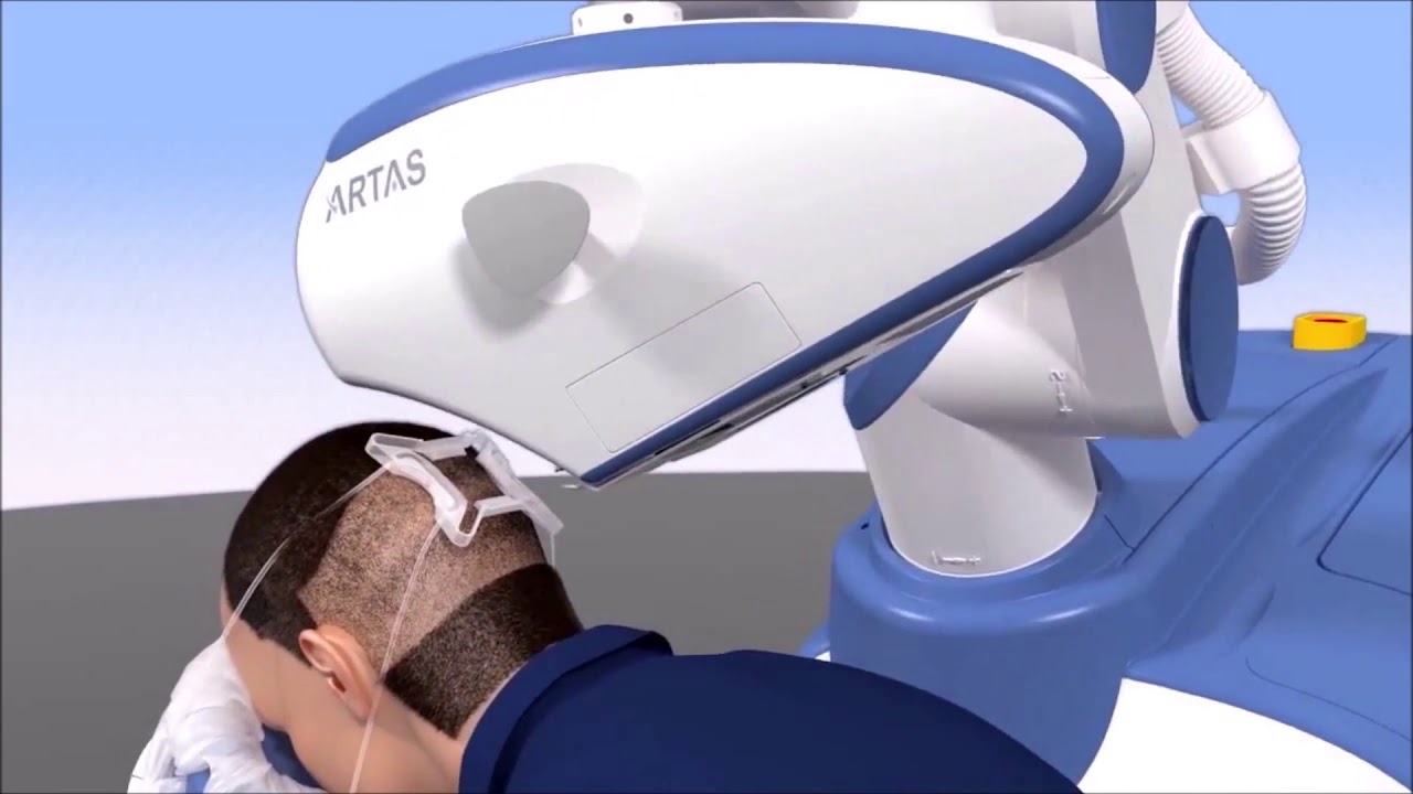 ARTAS FUE: Nuhair Medical - Hair Transplant Vancouver, Edmonton, Calgary, Winnipeg, Saskatoon