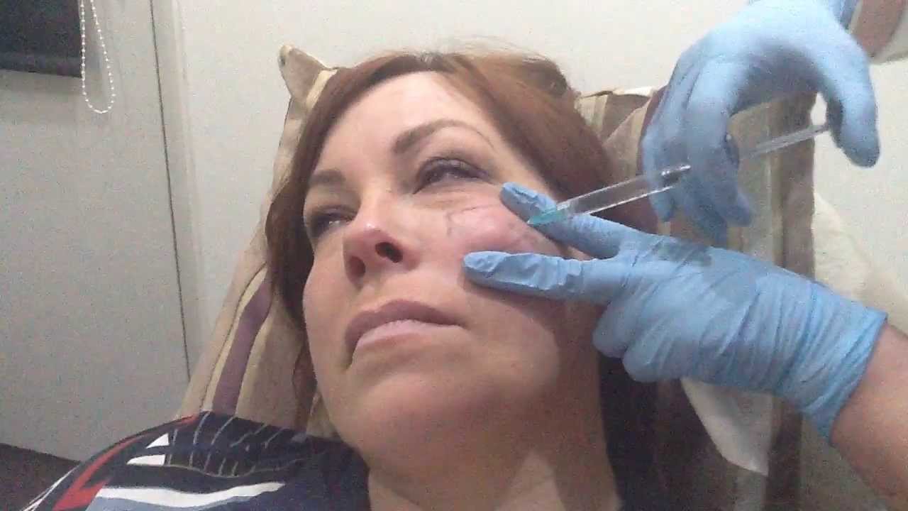 Cheek Augmentation with Juvederm Volift
