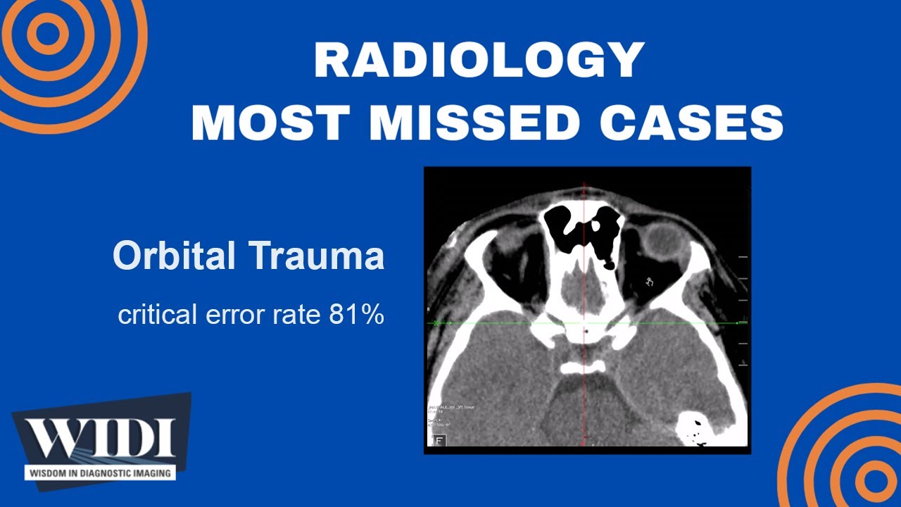 Most Missed Cases: Orbital Trauma