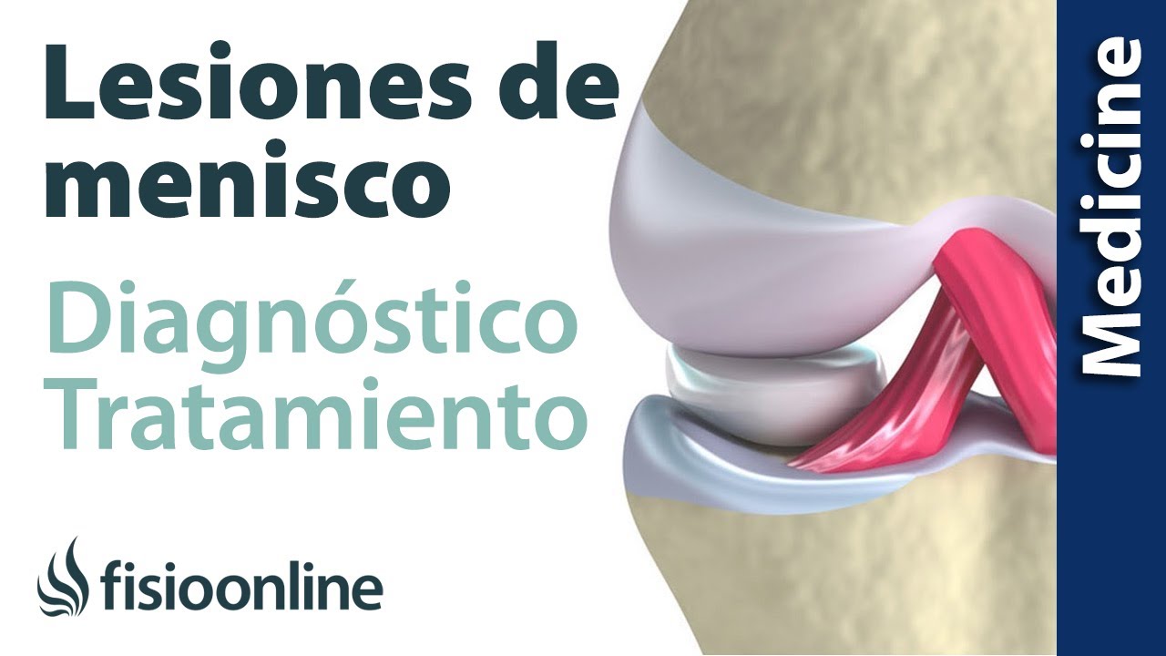 😩😩ROTURA DE MENISCO ► Diagn&oacute;stico y tratamiento de fisioterapia, m&eacute;dico y quir&uacute;rgico