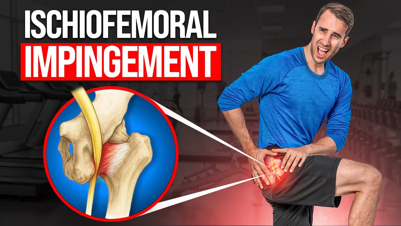 Ischiofemoral Impingement: A Pain in the Butt—Literally