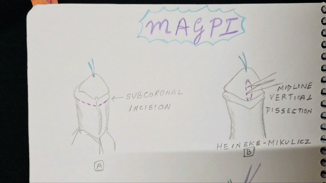 Гипоспадия - MAGPI