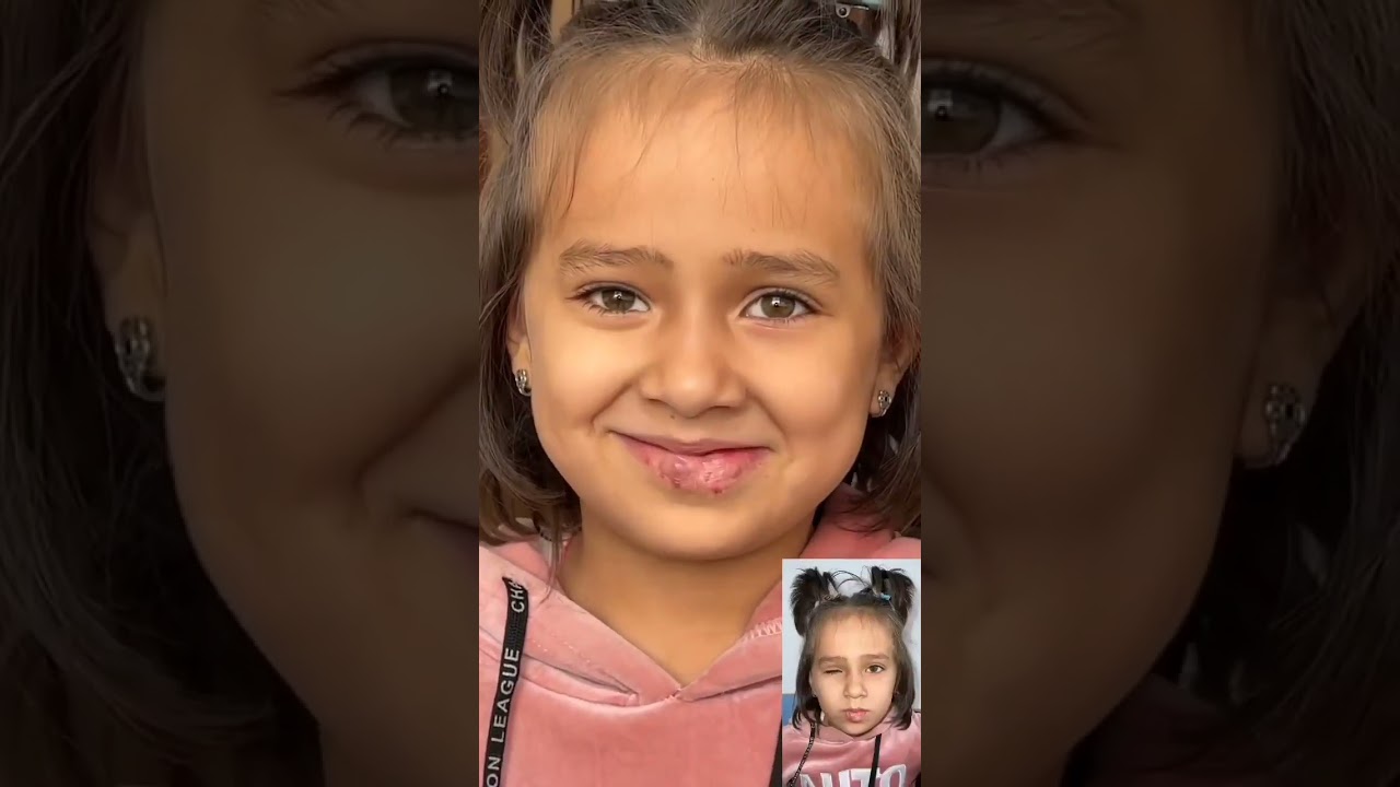 Глазное протезирование, город Ташкент. Узбекистан.