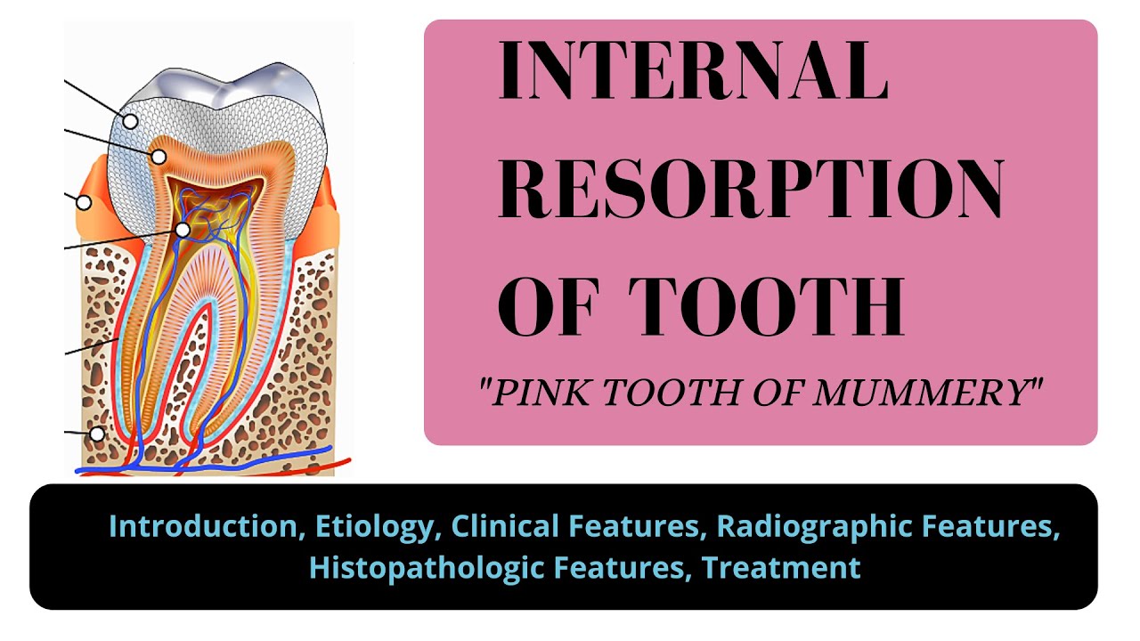 INTERNAL RESORPTION OF TOOTH I PINK TOOTH OF MUMMERY I ODONTOCLASTOMA I ORAL PATHOLOGY
