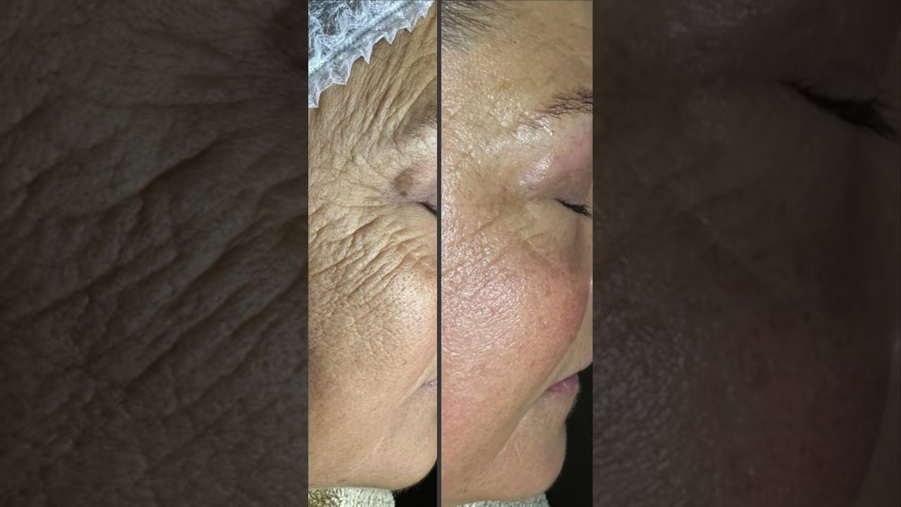 Distendi le rughe senza bisturi - Aura estetica avanzata