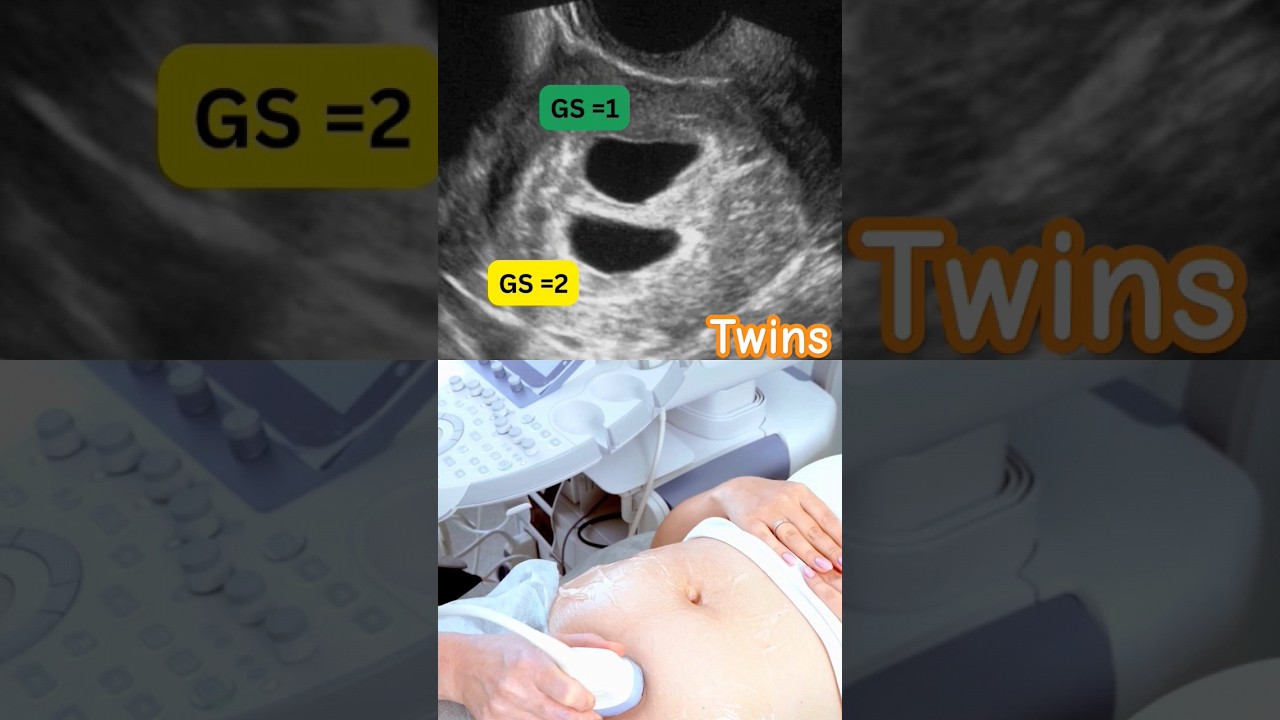Early Ultrasound Shows Twins #twins #pregnancy #ultrasound