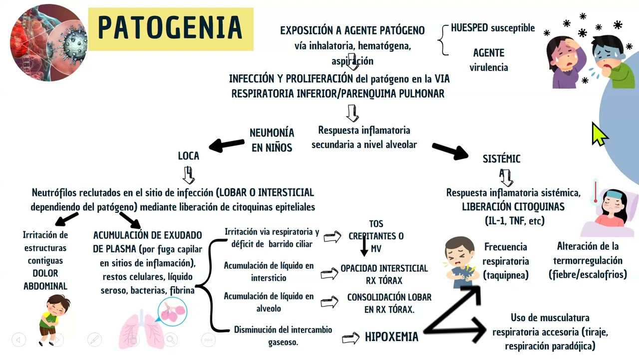 TELECAPACITACION NEUMONÍA EN PEDIATRÍA DRA  CARLA CORTIJO ALFARO