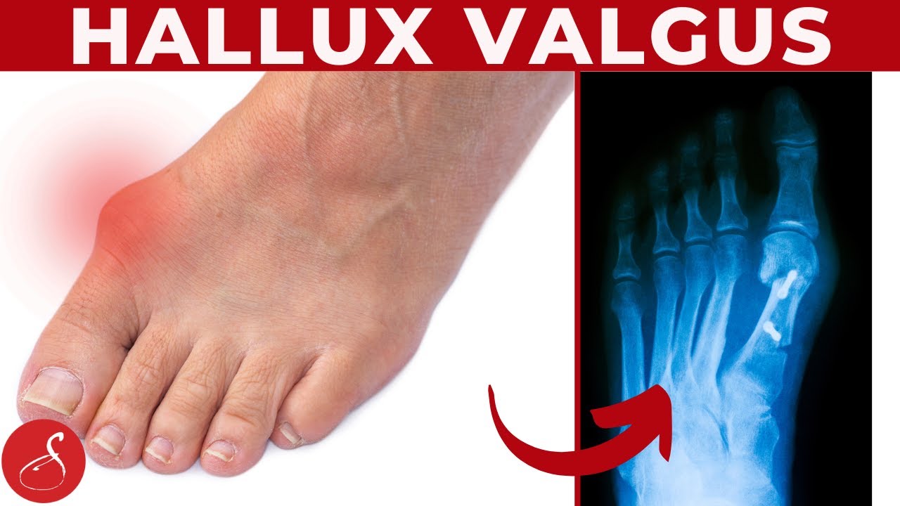 Hallux Valgus ganz einfach loswerden │ SanoGym