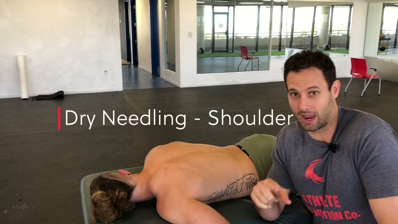 Dry Needling - Shoulder