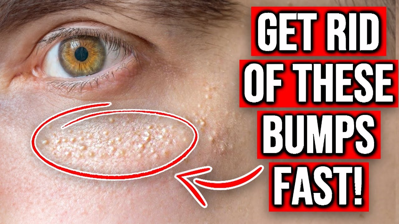GET RID OF MILIA FAST & PREVENT IT! (GUARANTEED FIX)