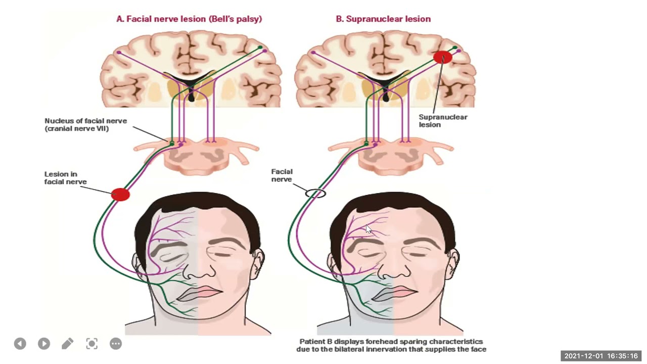 Kuliah Neuroanatomi Saraf Kranial 5 dan 7