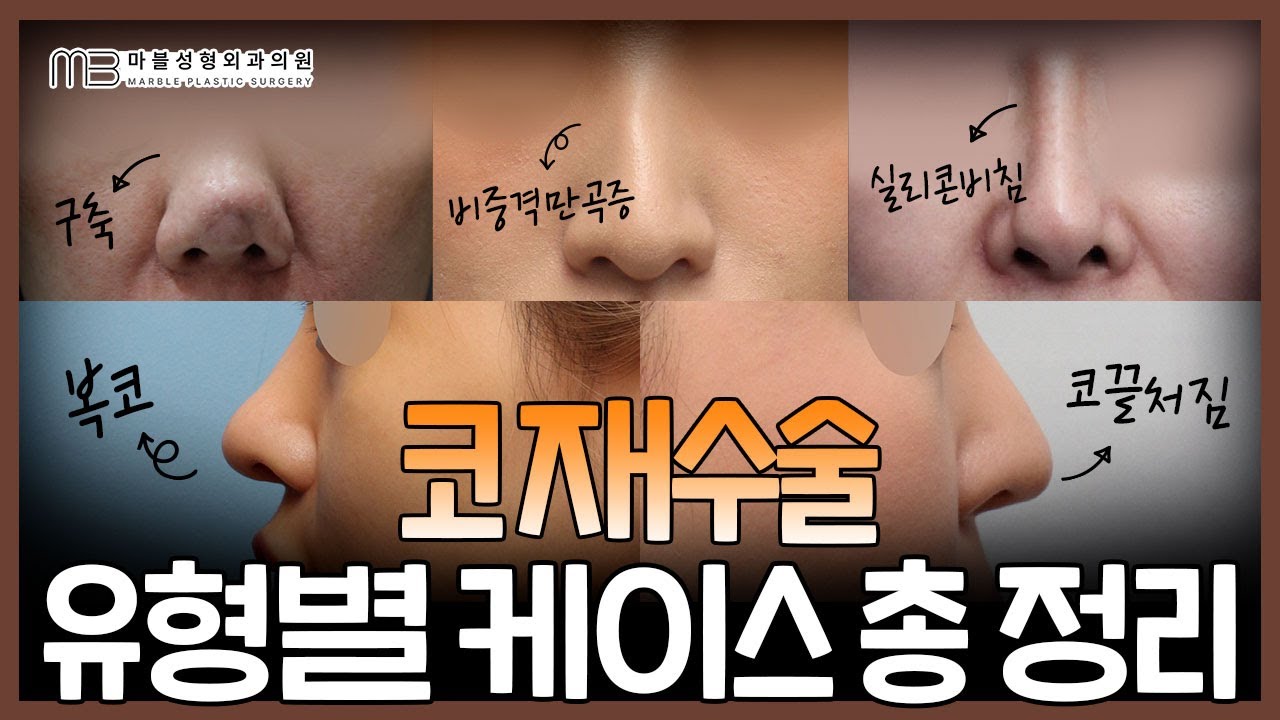 코재수술, 전후사진으로 보는 4가지