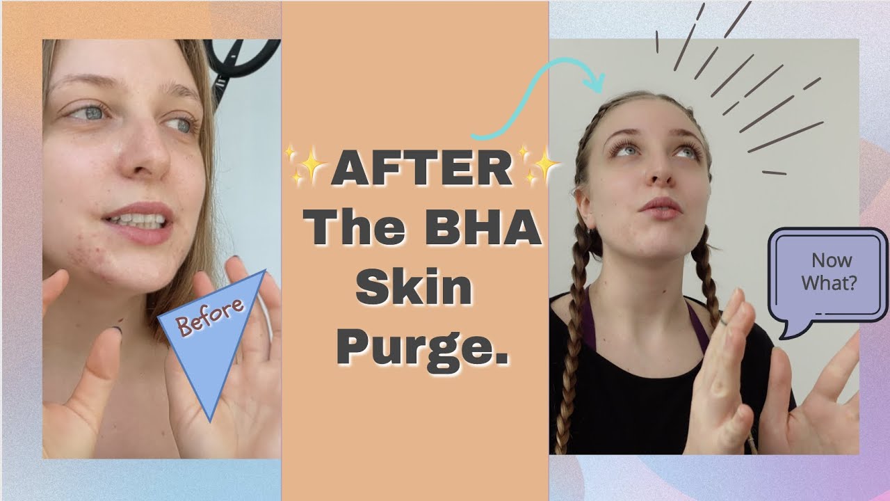 BHA Salicylic Acid Part 4: After Skin Purging | Healing Scars, Hyperpigmentation & Moisture Barrier
