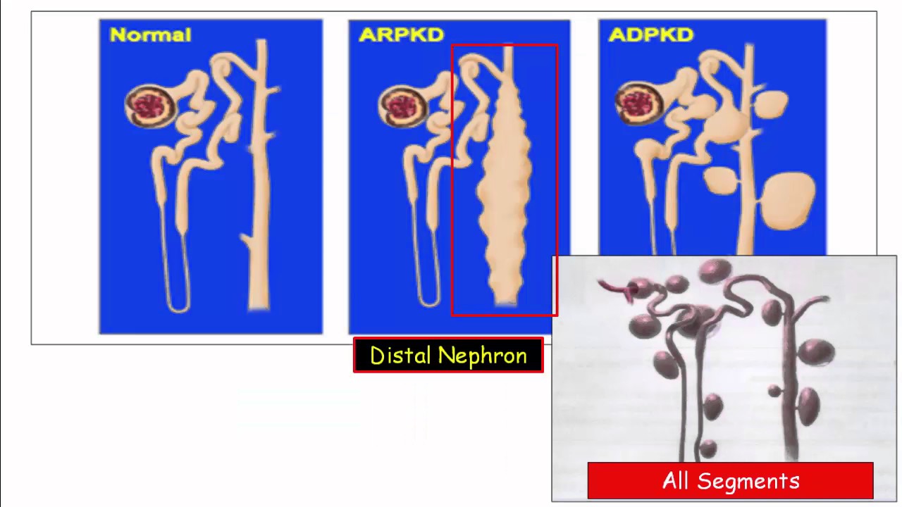 12DaysinMarch, Cystic Renal Diseases for USMLE Step One