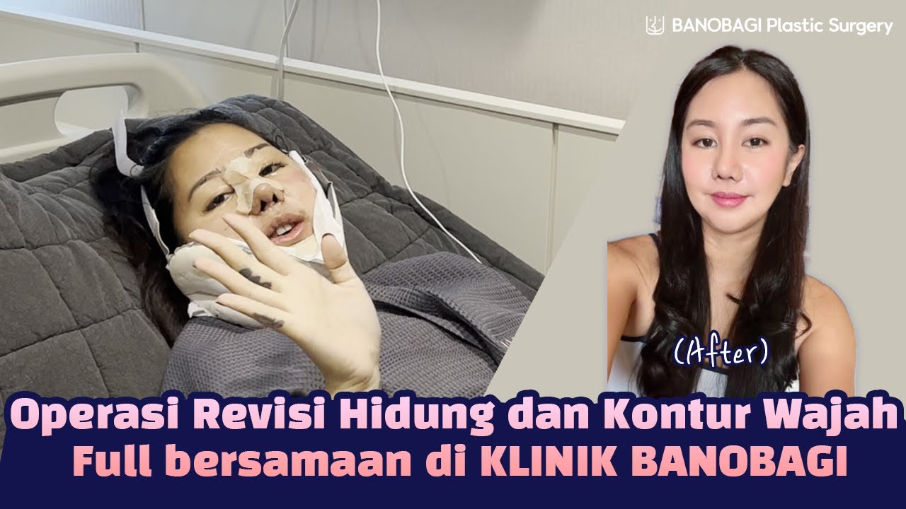 Operasi Revisi Hidung dan Kontur Wajah Chika Kinsky di BANOBAGI