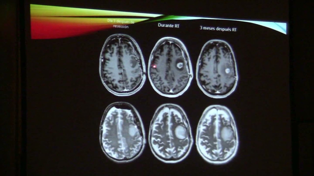 Imaging in the Diagnosis and Treatment of Glioblastoma. Camilo Jaimes Cobos