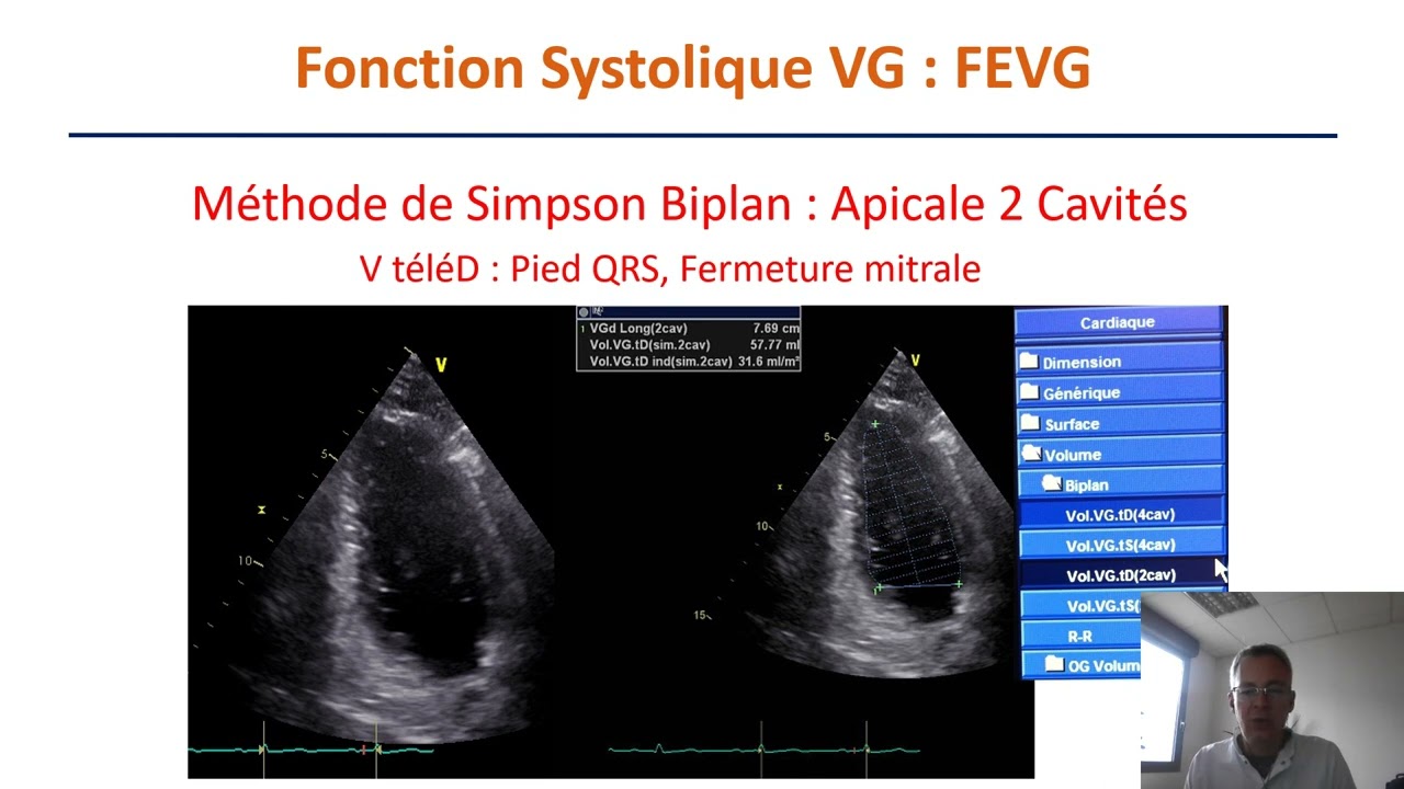 Présentation fonction systolique ventriculaire en échocardiographie transthoracique