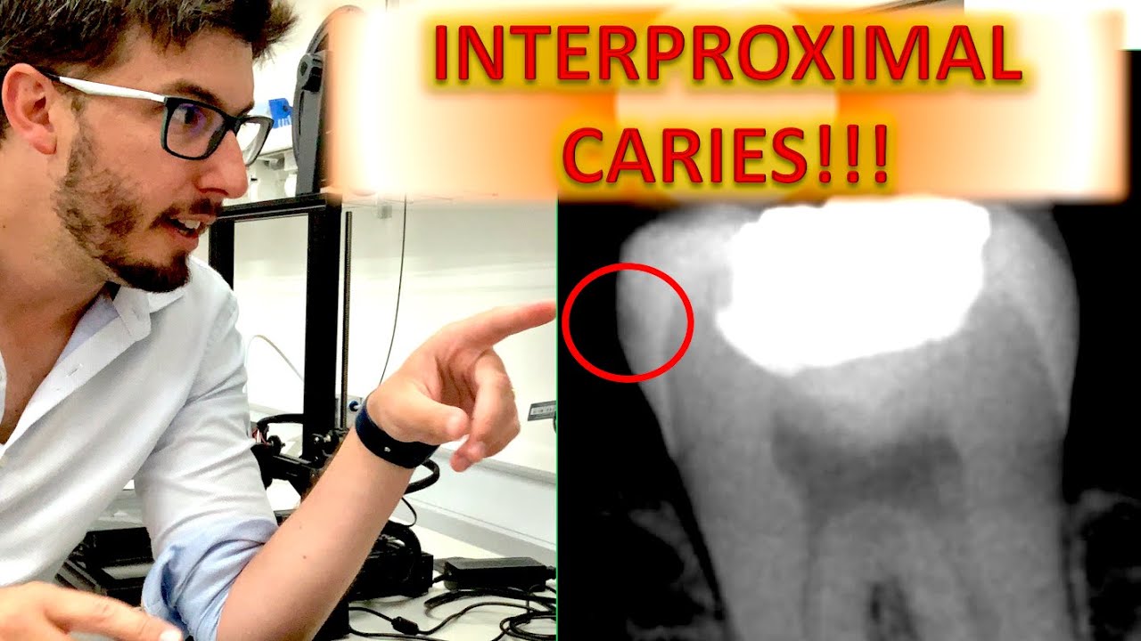 ALL ABOUT Interproximal Caries (Radiology Tutorial: How to read bitewings and periapical radiograph)