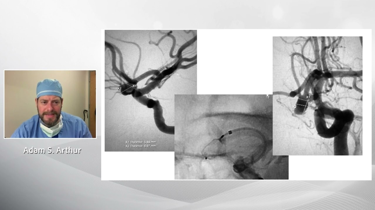 Safe and exemplary occlusion for wide neck bifurcation aneurysms using the Microvention WEB system