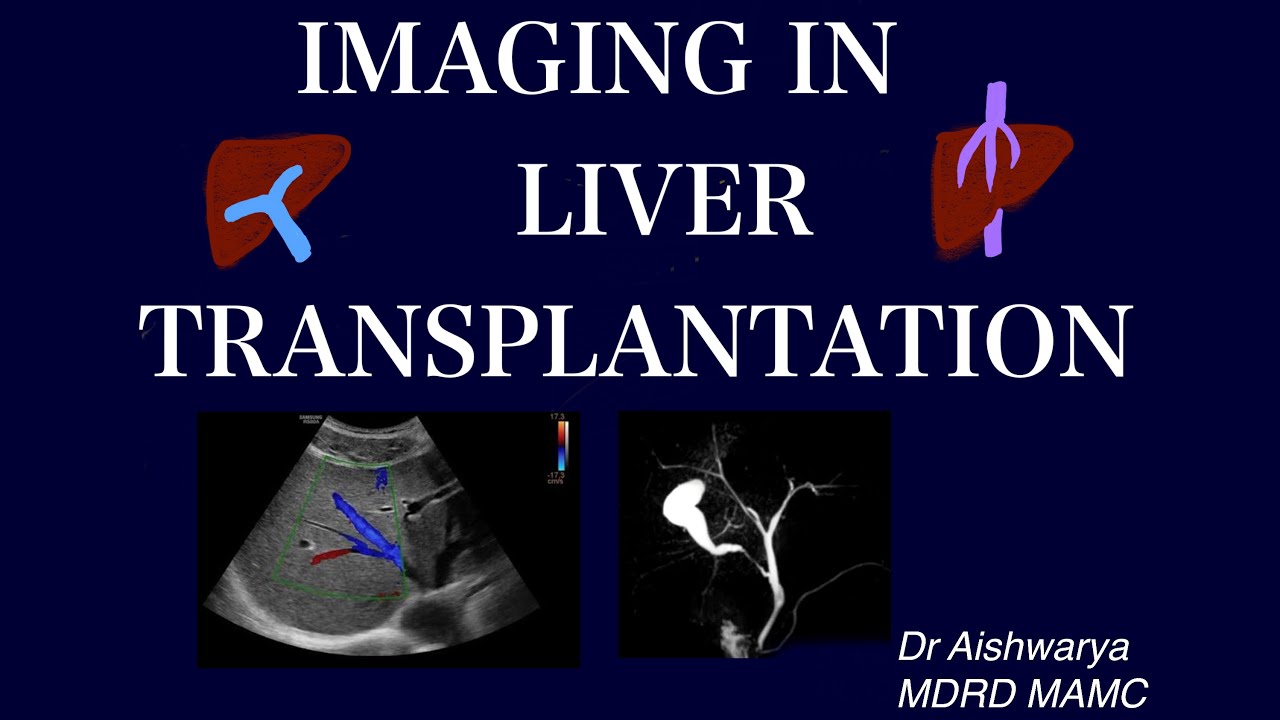 IMAGING IN LIVER TRANSPLANTATION l Criteria l Donor and recipient imaging l Pre and Post op imaging