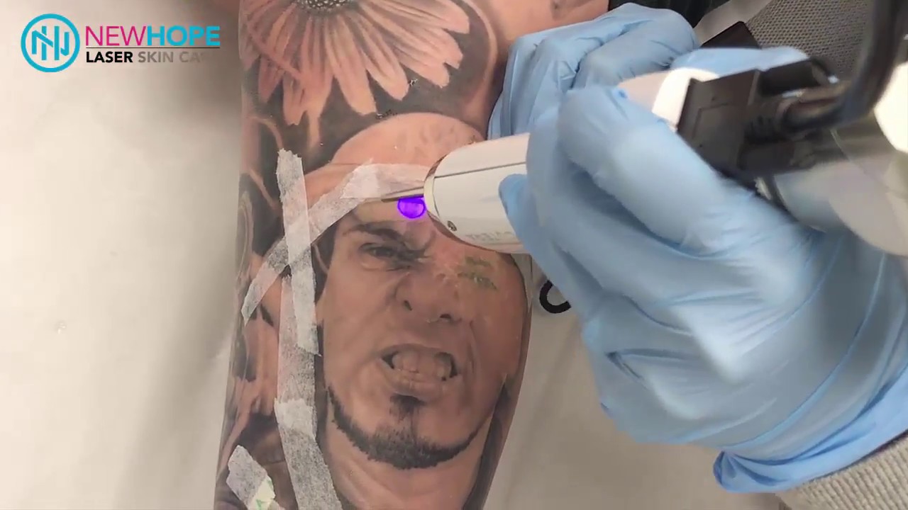Laser Tattoo Removal - Removing Portrait Tattoo - Newhope Laser Skin Care - Orange County