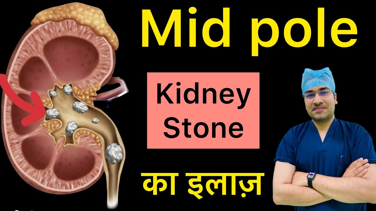 Mid Pole में Kidney Stones कैसे निकालें? | Kidney Stones In MID Pole : How do we remove it? #kidney