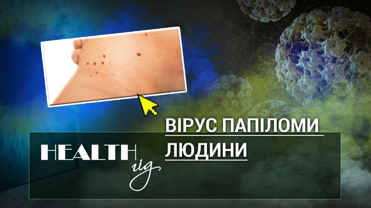 «Health - гід». Вірус папіломи людини