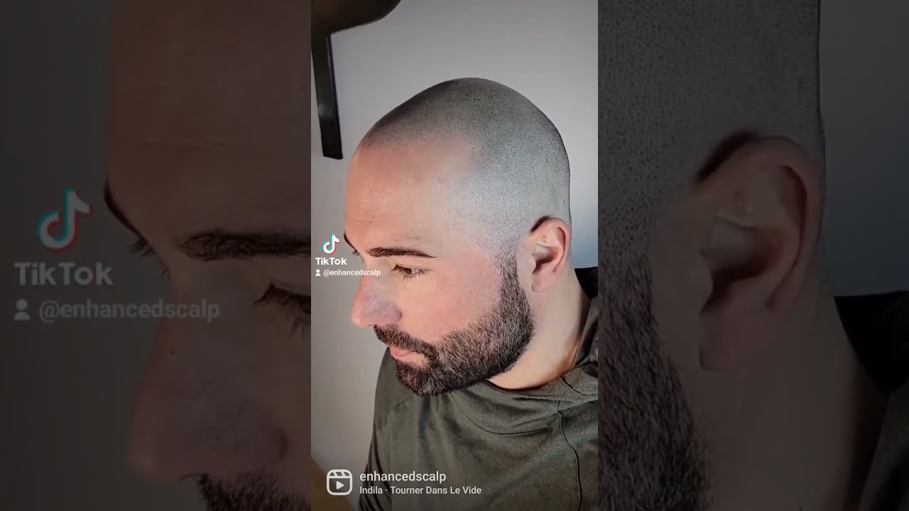 Life changing tattoo #scalpmicropigmentation #hairtattoo #hairstyle #scalp #bald #hairline #tate