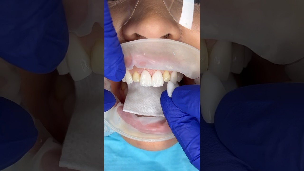 Placing top 10 porcelain veneers 🦷 #veneers #dentalveneers #veneers_smile #porcelainveneers #teeth