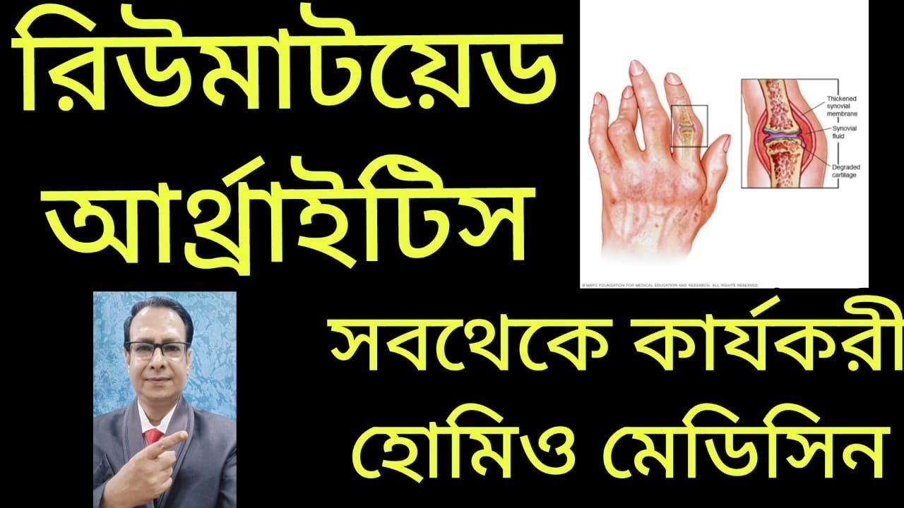 রিউমাটয়েড আর্থ্রাইটিস এর কার্যকরী হোমিও মেডিসিন/EFFECTIVE HOMOEO MEDICINE FOR RHEUMATOID ARTHRITIS