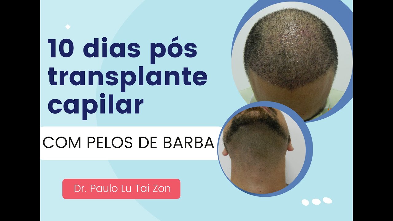 Veja resultado real transplante cabelo fue 10 dias em calvície grau 5/6 giga sessão c/ pelo corporal