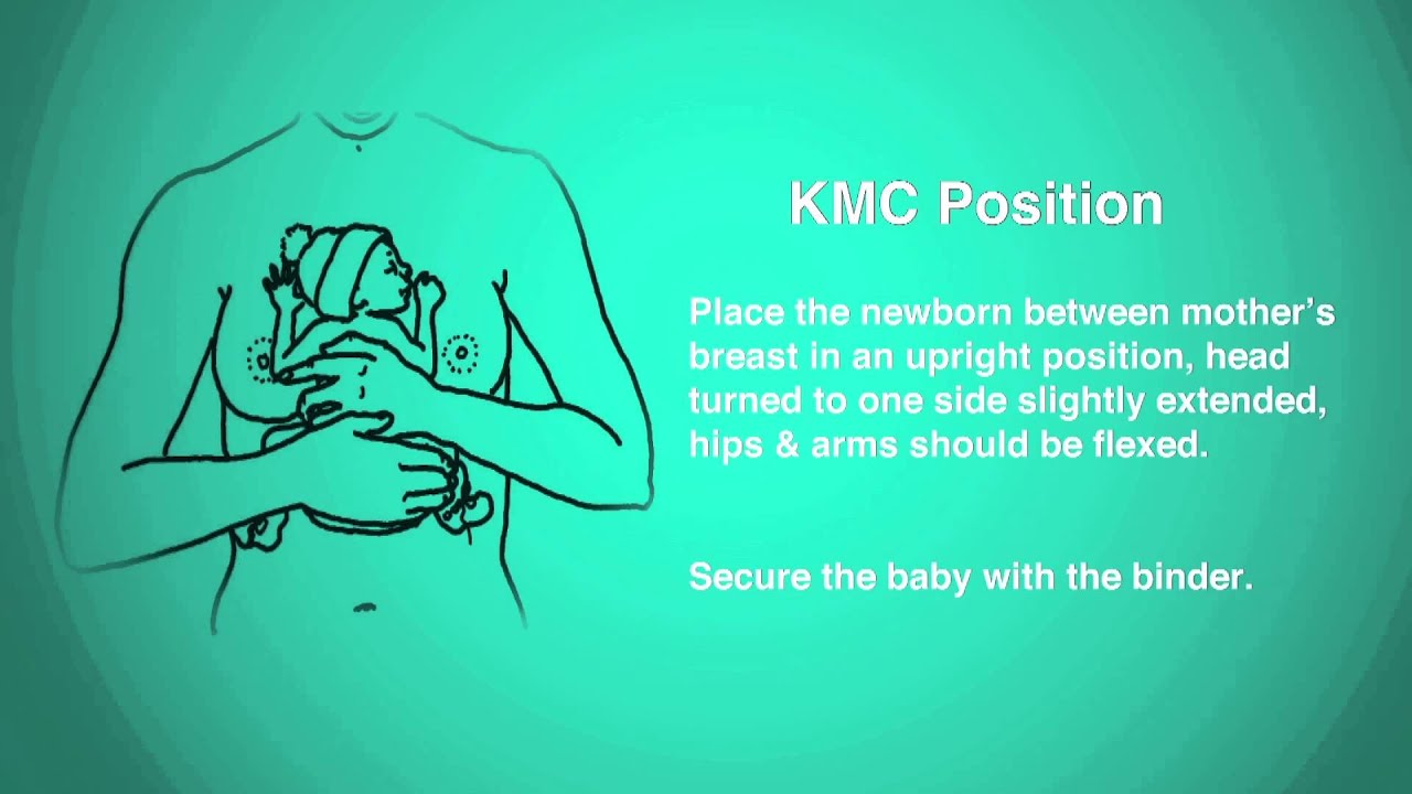 Метод кенгуру-матери (KMC)