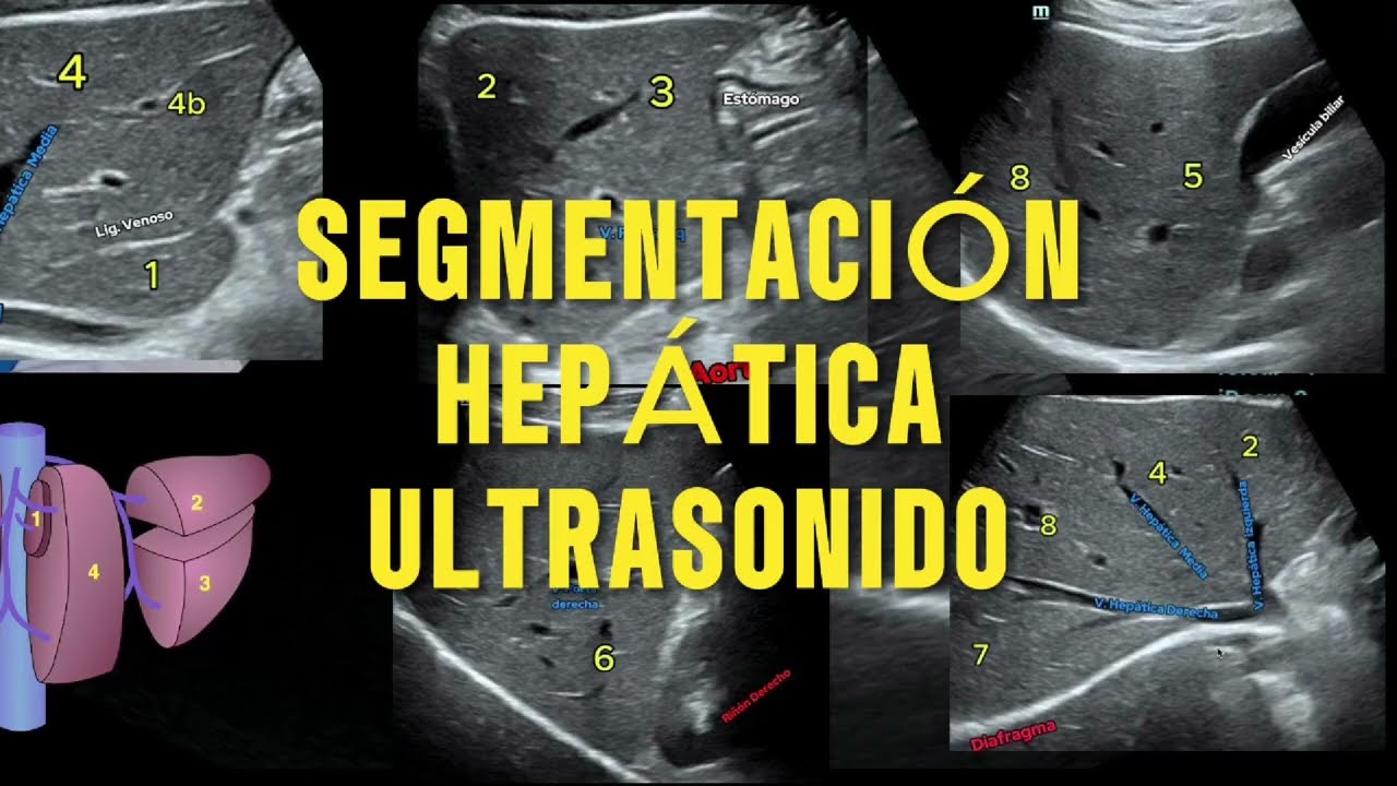 Domina la Segmentación Hepática con Ultrasonido: Guía Rápida y Precisa de Couinaud