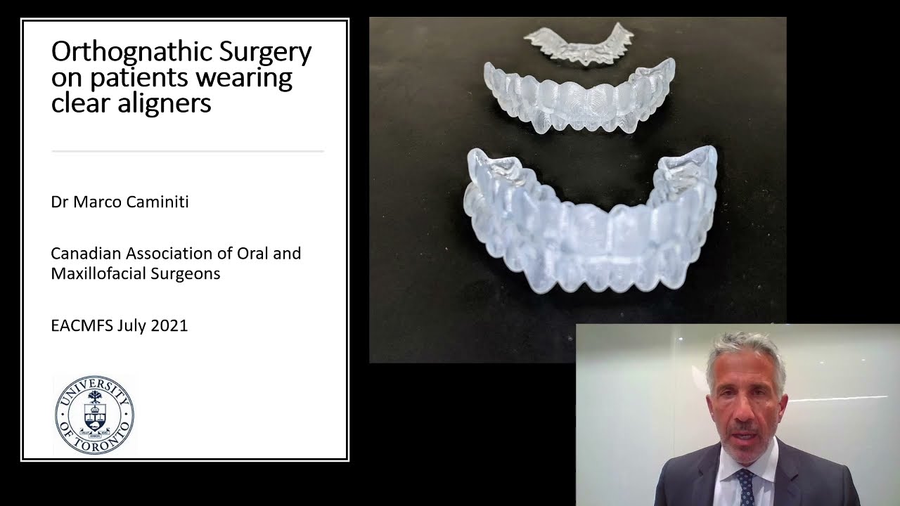 Orthognathic Surgery with Clear Aligners EACMFS July 2021 Dr. M. Caminiti