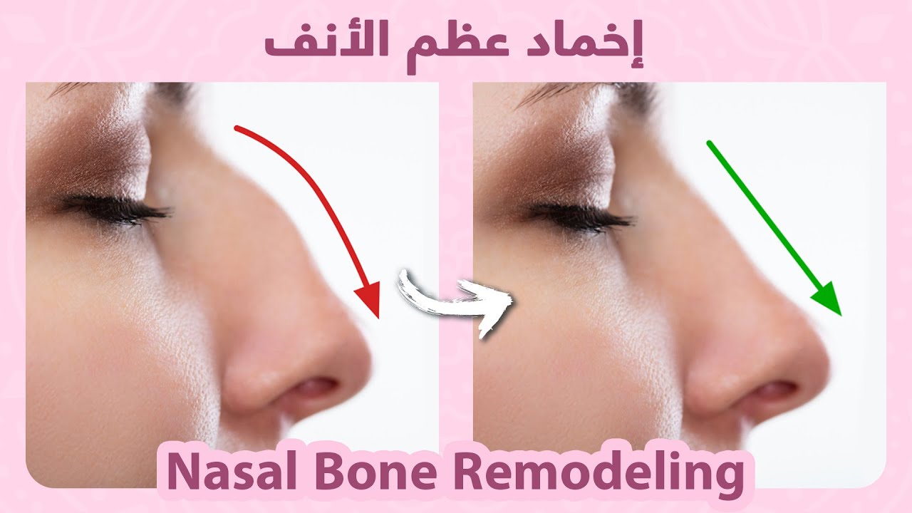 How to naturally get rid of nose hump | كيفية اخماد عظم الانف بطريقة طبيعية بدون جراحة