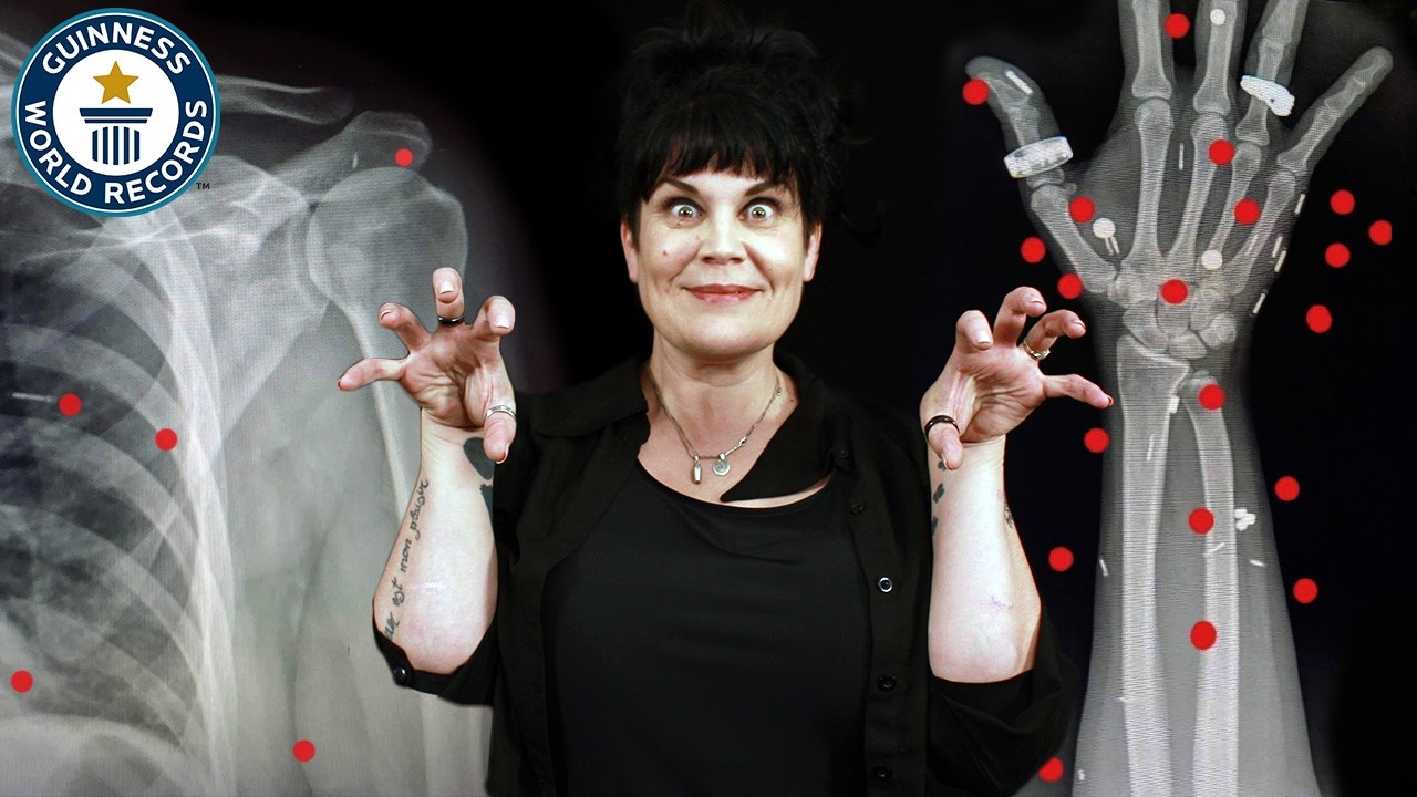 I Have Over 50 Implants In My Body! - Guinness World Records