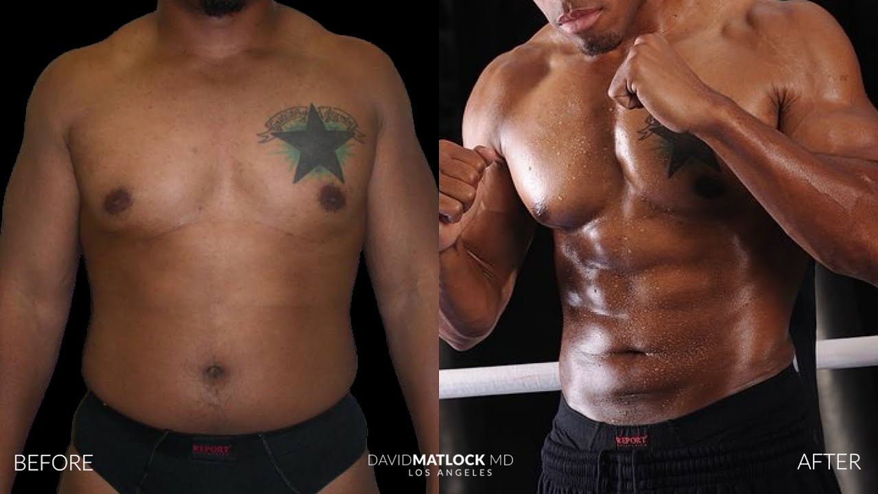 VASER Assisted Liposuction Technique