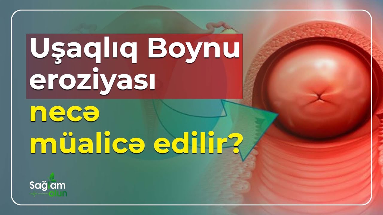 Uşaqlıq Boynu Eroziyası Necə Müalicə Edilir?