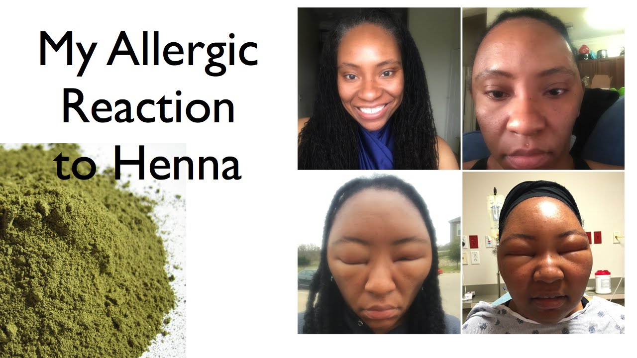 My Allergic Reaction to Henna