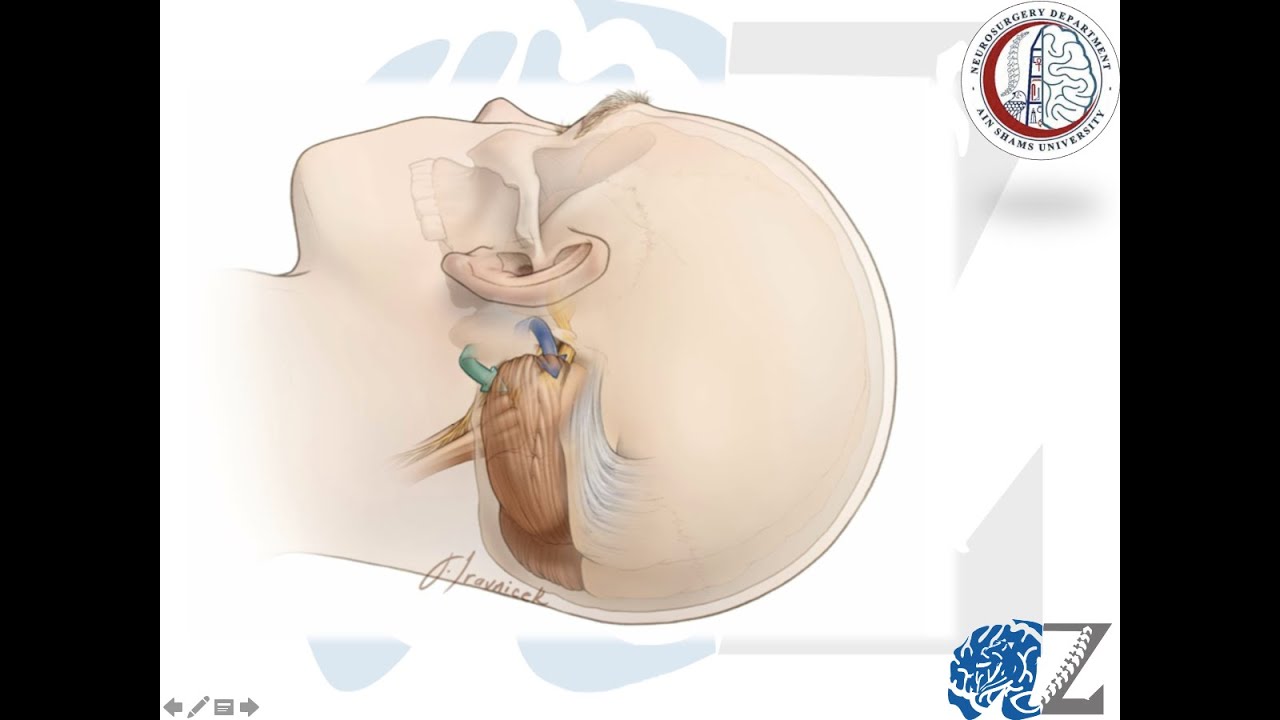 Cranial Approaches (10): ParaMedian Sub-Occipital/ RetroSigmoid Approaches
