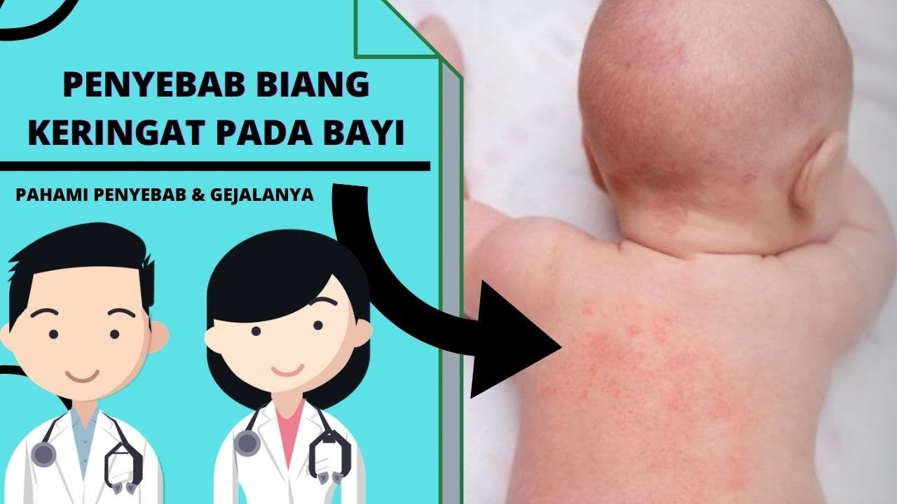 Penyebab Biang Keringat pada Bayi dan Cara Mencegahnya