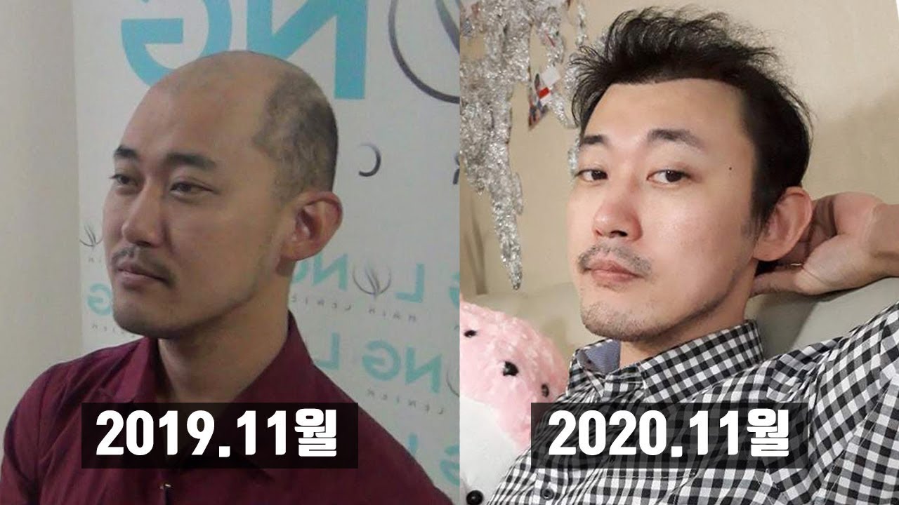 터키모발이식 1년 경과 비포에프터