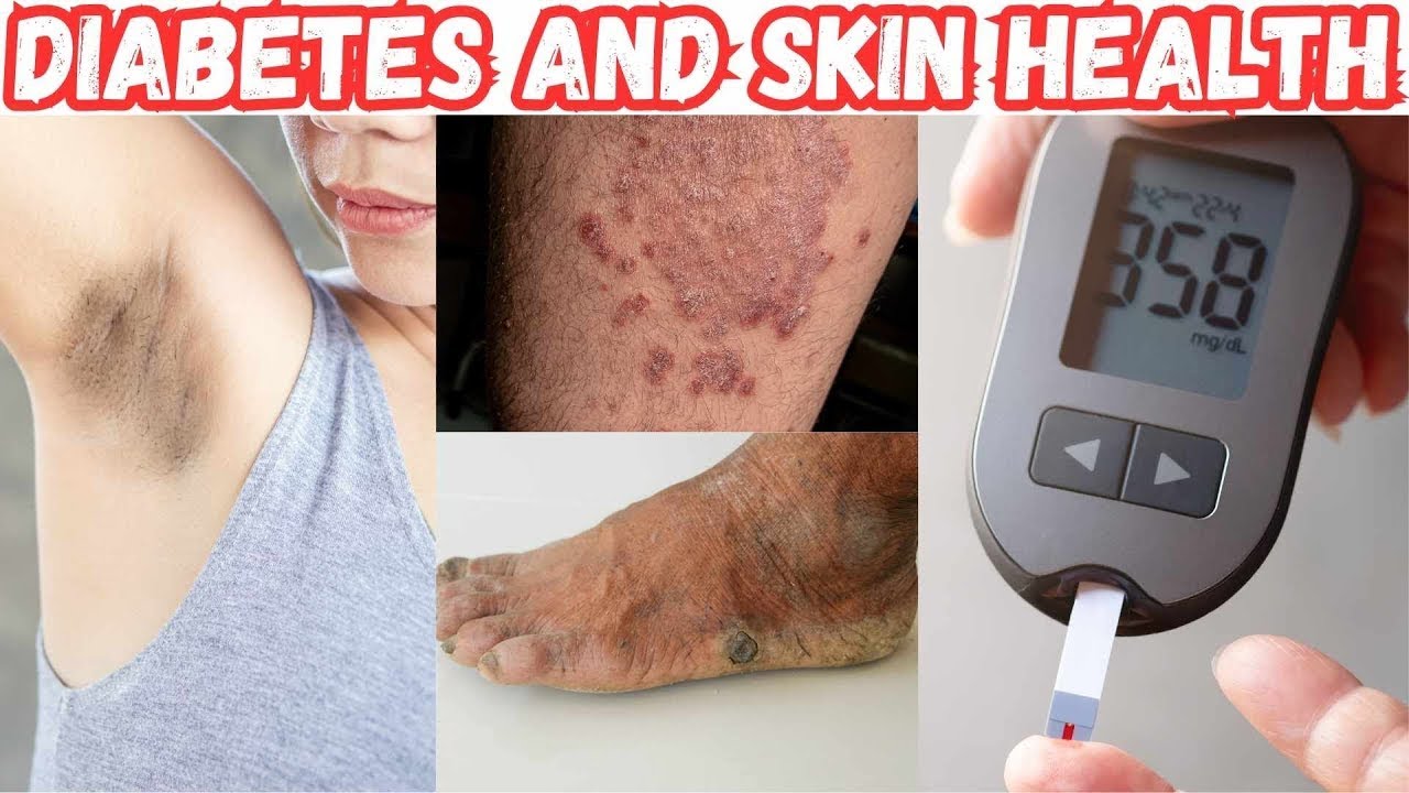 Diabetes and Skin Health: Understanding, Caring, and Treating Skin Conditions #diabetes #skincare